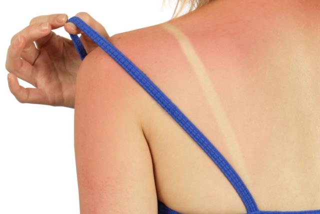Woman with sunburn (illustrative). (photo credit: INGIMAGE)
