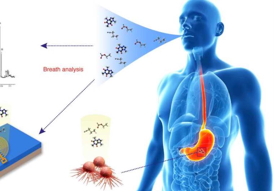 Israeli Doctors closer to detecting stomach cancer with breath test ...